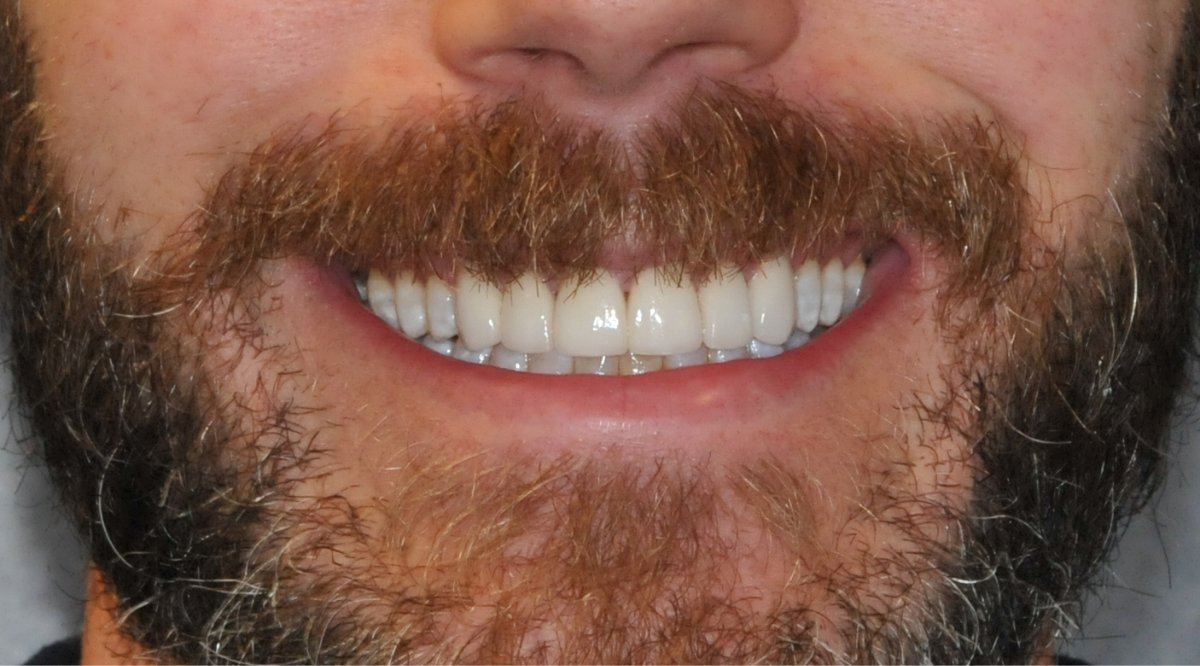 Before and after smiles at Alleman Family Dental Boulder, CO